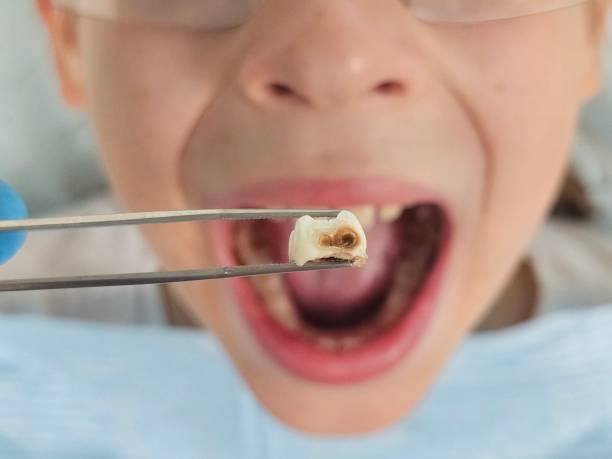 Best Emergency Wisdom Teeth Removal in Mckees Rocks, PA